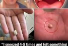 Here’s what you need to know about tonsil stones